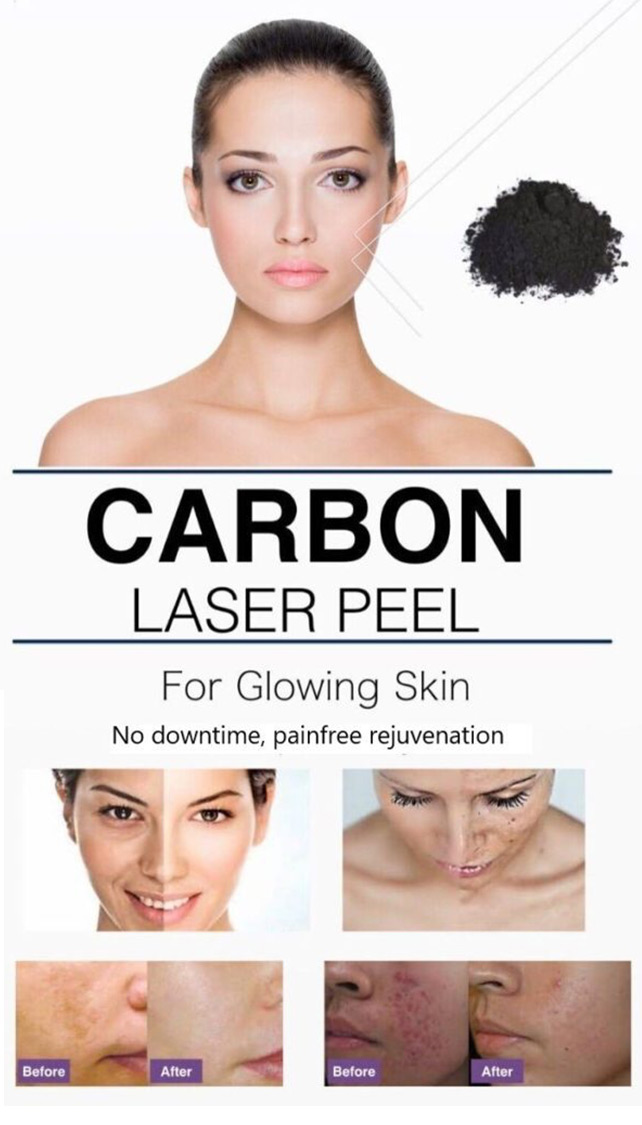CARBON LASER FACIAL Renew Skin Clinic